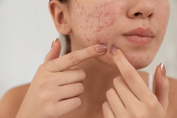 Best Acne-Pimple Treatment in Pimpri Chinchwad, Pune