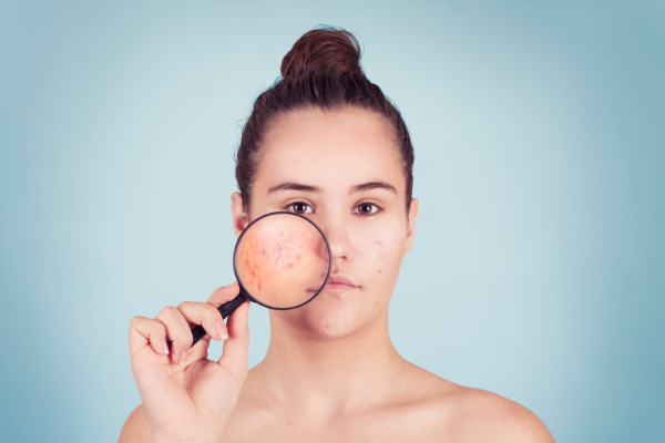 Acne Scar Treatment in Pimpri Chinchwad, Pune | Dr. Gauri Padmawar