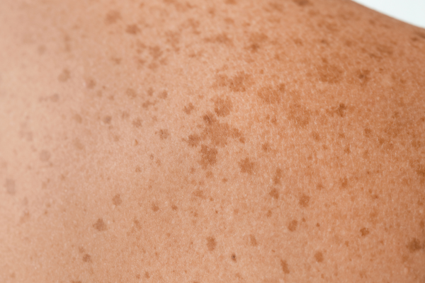 Best Freckle Removal Treatment in Pimpri Chinchwad, Pune