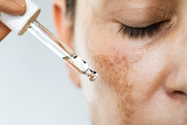Best Melasma Pigmentation Treatment in Pimpri Chinchwad, Pune