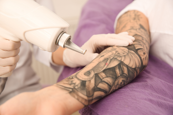 Advanced Tattoo Removal Treatment in Pimpri Chinchwad, Pune
